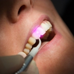 Dental Laser Zahnbehandlung Zahnfleisch