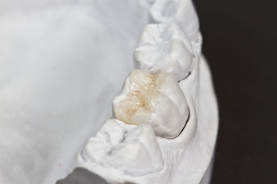 closeup for dental onlay on a molar tooth shown on a plaster model