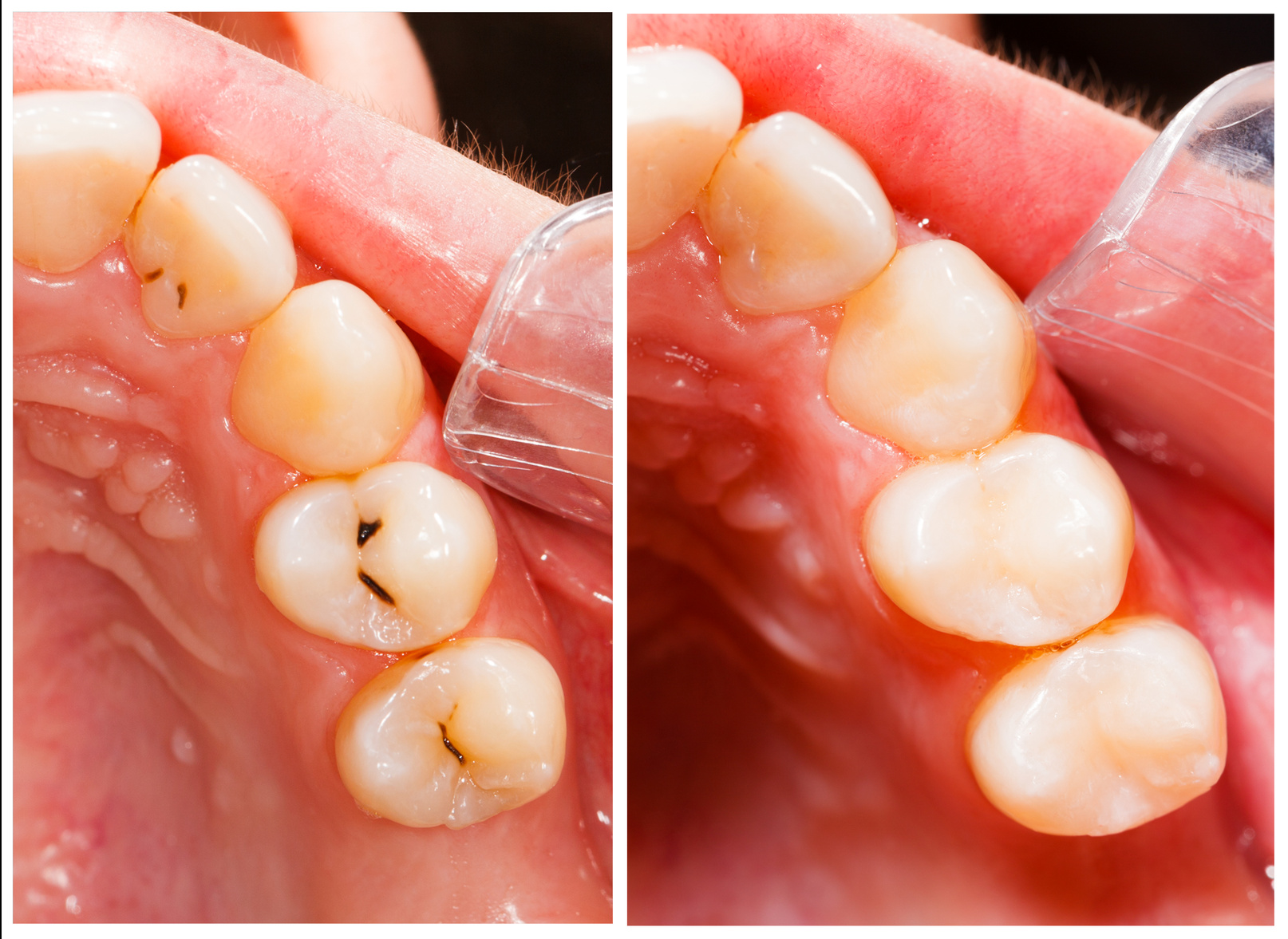 White Fillings